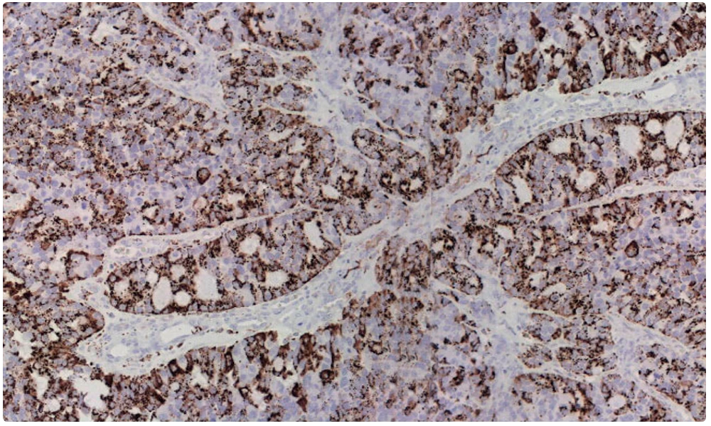 Cabeceras Pleuropulmonar