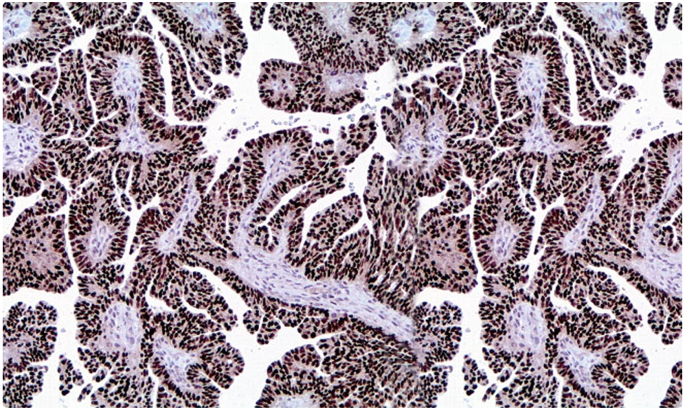 Cabeceras Tiroide